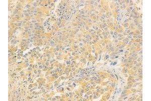 ABIN7095803 and ABIN7099865 at 1/100 staining human lung squamous cell carcinoma by IHC-P. (CARS2 Antikörper)