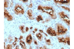 Formalin-fixed, paraffin-embedded human Prostate Carcinoma stained with FOLH1 (PSMA) Mouse Monoclonal Antibody (SPM500). (PSMA Antikörper  (AA 232-433))
