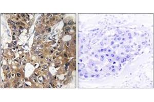 Immunohistochemistry analysis of paraffin-embedded human breast carcinoma tissue, using CD9 Antibody.