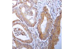 Immunohistochemical analysis of ACC alpha staining in human colon cancer formalin fixed paraffin embedded tissue section. (Acetyl-CoA Carboxylase alpha Antikörper  (N-Term))