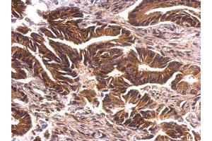 IHC-P Image PRK2 antibody [N1N3] detects PRK2 protein at cytosol on human colon carcinoma by immunohistochemical analysis.