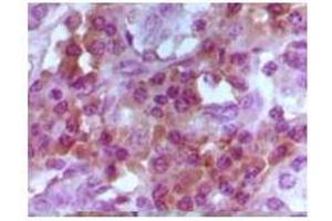 Immunohistochemical analysis of paraffin-embedded human lymphocyto tissue, showing cytoplasmic and nuclear localization using Foxp3 mouse mAb with DAB staining.