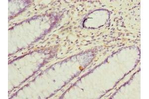 Immunohistochemistry of paraffin-embedded human colon cancer using ABIN7171111 at dilution of 1:100