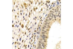 Immunohistochemistry of paraffin-embedded human uterine cancer using DNMT3A Antibody (ABIN5971621) at dilution of 1/100 (40x lens).