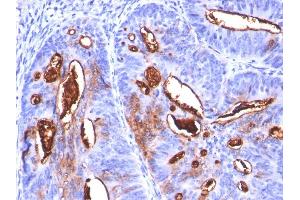 Formalin-fixed, paraffin-embedded human Colon Carcinoma stained with CA19-9 Monoclonal Antibody (SPM588). (CA 19-9 Antikörper)