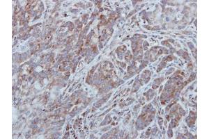 IHC-P Image Immunohistochemical analysis of paraffin-embedded A549 xenograft, using UNC13B, antibody at 1:500 dilution.
