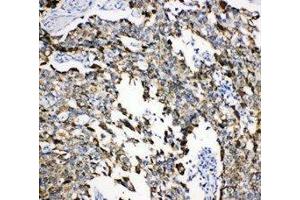 Anti-Grp75 antibody, IHC(P) IHC(P): Human Lung Cancer Tissue (HSPA9 Antikörper  (C-Term))