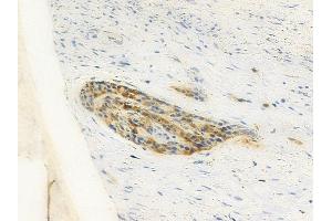 ABIN6260813 and ABIN6277925 at 1/100 staining human esophageal carcinoma by IHC-P. (Choline Acetyltransferase Antikörper  (C-Term))
