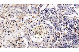 Detection of CXCR4 in Human Lung cancer Tissue using Polyclonal Antibody to Chemokine C-X-C-Motif Receptor 4 (CXCR4) (CXCR4 Antikörper  (AA 262-352))