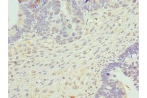 Immunohistochemistry of paraffin-embedded human ovarian cancer using ABIN7149288 at dilution of 1:100 (Cytohesin 2 Antikörper  (AA 150-350))