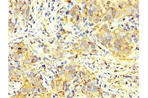 IHC image of ABIN7166908 diluted at 1:400 and staining in paraffin-embedded human pancreatic cancer performed on a Leica BondTM system. (PKM Antikörper  (AA 185-461))