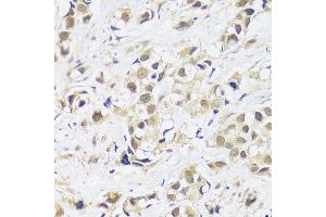 Immunohistochemistry of paraffin-embedded human breast cancer using  antibody (ABIN7265374) at dilution of 1:100 (40x lens). (ASCL4 Antikörper  (AA 1-172))
