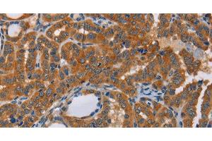 Immunohistochemistry of paraffin-embedded Human thyroid cancer tissue using CK-13 Polyclonal Antibody at dilution 1:50 (Cytokeratin 13 Antikörper)