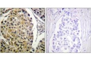 Immunohistochemistry analysis of paraffin-embedded human breast carcinoma, using PKC delta (Phospho-Tyr313) Antibody. (PKC delta Antikörper  (pTyr313))