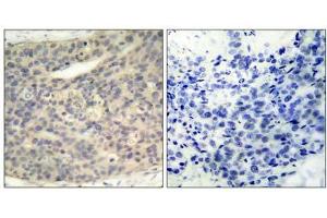 Immunohistochemical analysis of paraffin- embedded human breast carcinoma tissue, using LIMK1 (phospho- Thr508) antibody (E011126). (LIM Domain Kinase 1 Antikörper  (pThr508))