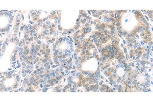 Immunohistochemistry of paraffin-embedded Human thyroid cancer using MAGED1 Polyclonal Antibody at dilution of 1:30