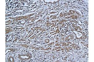 Formalin-fixed and paraffin embedded human cervical cancer labeled with Anti-ADAR1 (N-terminus) Polyclonal Antibody, Unconjugated (ABIN678218) followed by conjugation to the secondary antibody and DAB staining (ADAR Antikörper  (AA 151-250))