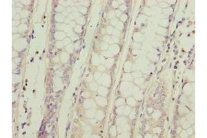 Immunohistochemistry of paraffin-embedded human colon cancer using ABIN7169615 at dilution of 1:100 (SPCS2 Antikörper  (AA 7-86))