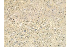 ABIN6261001 and ABIN6279253 at 1/100 staining human hepatocellular carcinoma by IHC-P. (CPD Antikörper  (N-Term))