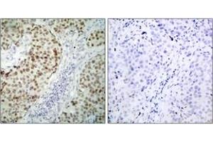 Immunohistochemistry analysis of paraffin-embedded human breast carcinoma tissue, using p53 (Ab-6) Antibody. (p53 Antikörper  (AA 1-50))