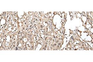 Immunohistochemistry of paraffin-embedded Human colorectal cancer tissue using UTP3 Polyclonal Antibody at dilution of 1:40(x200)