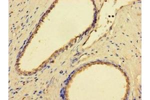 Immunohistochemistry of paraffin-embedded human prostate cancer using ABIN7158978 at dilution of 1:100 (GMPPB Antikörper  (AA 61-360))