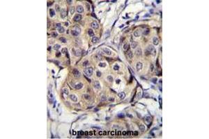 CBLN2 Antibody (C-term) immunohistochemistry analysis in formalin fixed and paraffin embedded human breast carcinoma followed by peroxidase conjugation of the secondary antibody and DAB staining. (CBLN2 Antikörper  (C-Term))