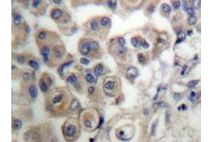 Immunohistochemistry analyzes of PLC β3 antibody in paraffin-embedded human breast carcinoma tissue. (PLCB3 Antikörper)