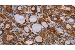 Immunohistochemistry of paraffin-embedded Human thyroid cancer tissue using FABP3 Polyclonal Antibody at dilution 1:40 (FABP3 Antikörper)
