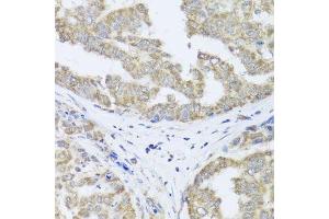 Immunohistochemistry of paraffin-embedded human liver cancer using TIMM10B antibody.