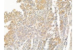 ABIN6263107 and ABIN6267016 at 1/100 staining human lung squamous cell carcinoma by IHC-P. (MAP3K4 Antikörper  (N-Term))