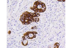 Paraformaldehyde-fixed, paraffin embedded Human stomach carcinoma tissue, Antigen retrieval by boiling in sodium citrate buffer (pH6) for 15min, Block endogenous peroxidase by 3% hydrogen peroxide for 30 minutes, Blocking buffer at 37°C for 20min, Antibody incubation with Cytokeratin 19 (2F3) Monoclonal Antibody  at 1:50 overnight at 4°C, followed by a conjugated secondary and DAB staining. (Cytokeratin 19 Antikörper)
