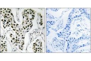 Immunohistochemistry analysis of paraffin-embedded human breast carcinoma tissue, using ZC3H4 Antibody. (ZC3H4 Antikörper  (AA 771-820))
