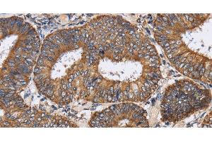 Immunohistochemistry of paraffin-embedded Human colon cancer tissue using PDGFC Polyclonal Antibody at dilution 1:40 (PDGFC Antikörper)
