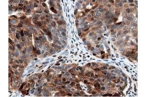Immunohistochemical staining of paraffin-embedded Adenocarcinoma of Human colon tissue using anti-NT5DC1 mouse monoclonal antibody. (NT5DC1 Antikörper)
