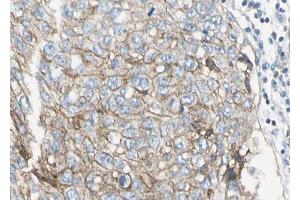 ABIN6268724 at 1/100 staining human lung carcinoma sections by IHC-P. (PAI1 Antikörper  (Internal Region))