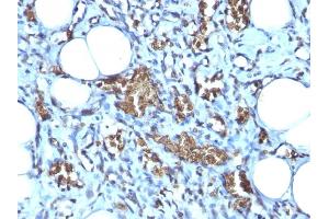 Formalin-fixed, paraffin-embedded human Angiosarcoma stained with Glycophorin A Mouse Monoclonal Antibody (GYPA/280). (CD235a/GYPA Antikörper)