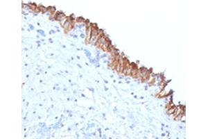IHC testing of FFPE human bladder carcinoma with MAML2 antibody (clone MMLP2-1). (MAML2 Antikörper)