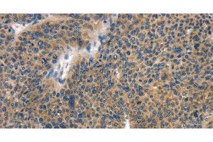 Immunohistochemistry of paraffin-embedded Human liver cancer tissue using COL4A2 Polyclonal Antibody at dilution 1:70 (COL4a2 Antikörper)