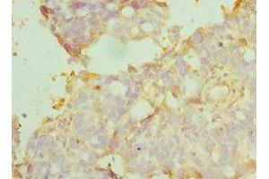 Immunohistochemistry of paraffin-embedded human endometrial cancer using ABIN7159417 at dilution of 1:100 (MANF Antikörper  (AA 25-182))
