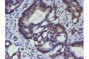 Immunohistochemical staining of paraffin-embedded Adenocarcinoma of Human colon tissue using anti-ELK3 mouse monoclonal antibody.