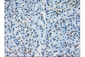 Immunohistochemical staining of paraffin-embedded Adenocarcinoma of colon tissue using anti-PRKYmouse monoclonal antibody. (PRKY Antikörper)