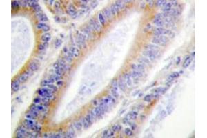 Immunohistochemistry analyzes of Casein Kinase I α antibody in paraffin-embedded human colon carcinoma tissue. (CSNK1A1 Antikörper)