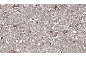 ABIN6277298 at 1/100 staining Human brain cancer tissue by IHC-P.