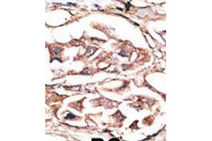 Formalin-fixed and paraffin-embedded human cancer tissue reacted with the primary antibody, which was peroxidase-conjugated to the secondary antibody, followed by AEC staining. (DKK2 Antikörper  (C-Term))