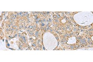 Immunohistochemistry of paraffin-embedded Human thyroid cancer tissue using CLTB Polyclonal Antibody at dilution of 1:70(x200) (CLTB Antikörper)