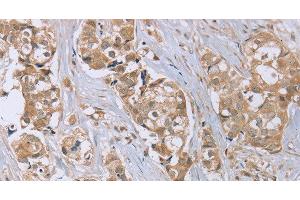 Immunohistochemistry of paraffin-embedded Human breast cancer tissue using RAB6C Polyclonal Antibody at dilution 1:45 (WTH3DI Antikörper)