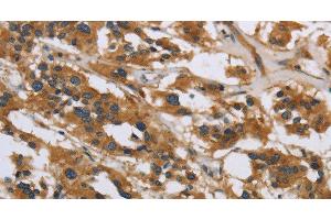 Immunohistochemistry of paraffin-embedded Human thyroid cancer using IL5RA Polyclonal Antibody at dilution of 1:40 (IL5RA Antikörper)