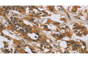 Immunohistochemistry of paraffin-embedded Human thyroid cancer using IL5RA Polyclonal Antibody at dilution of 1:40 (IL5RA Antikörper)