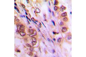 Immunohistochemical analysis of Aurora A staining in human lung cancer formalin fixed paraffin embedded tissue section. (Aurora A Antikörper  (C-Term))